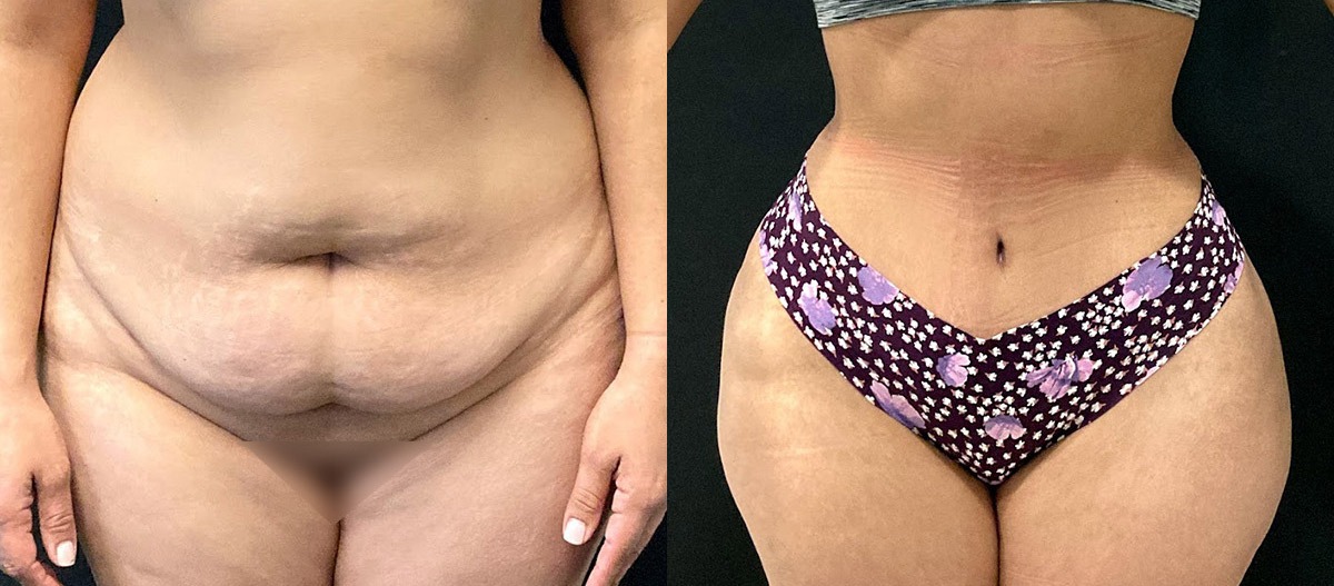 Abdominoplasty Before and After Photo by Dr. Jacobson in Beverly Hills California