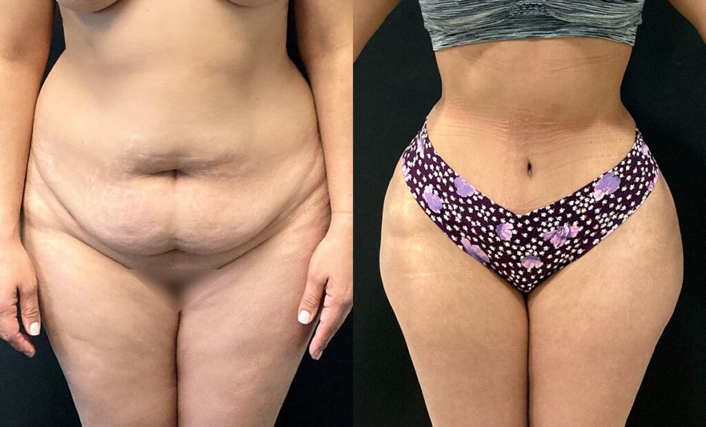 abdominoplasty before and after photo