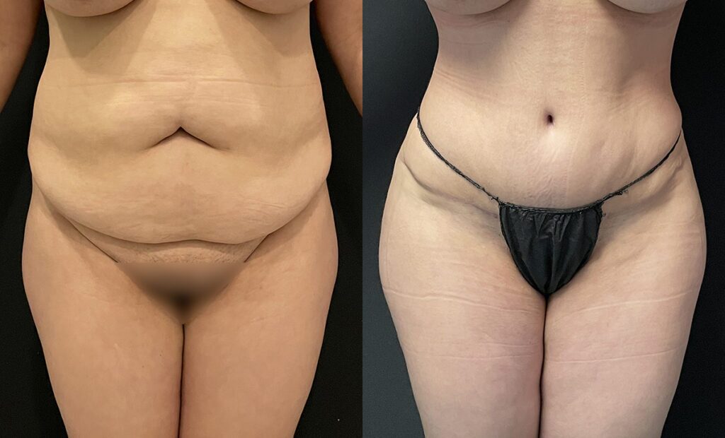 Abdominoplasty Before and After Photo by Dr. Jacobson in Beverly Hills California