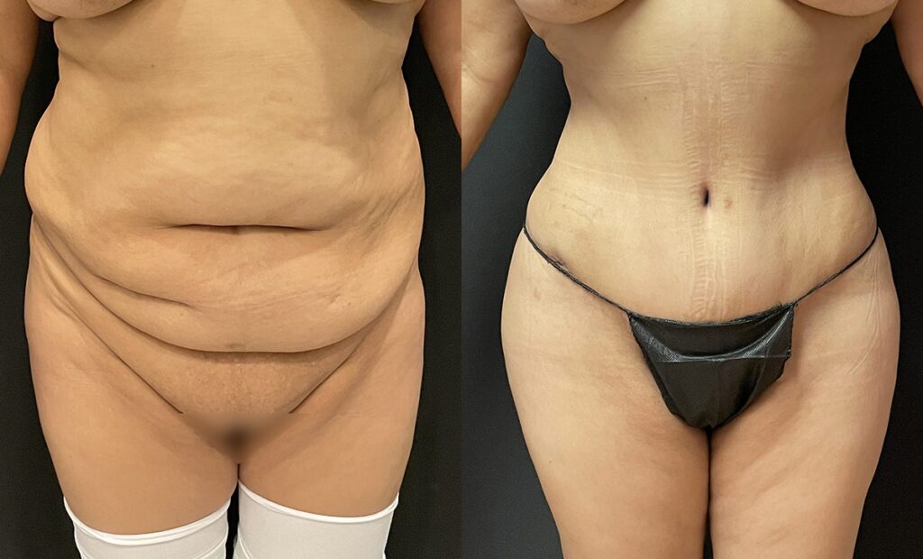 Abdominoplasty Before and After Photo by Dr. Jacobson in Beverly Hills California