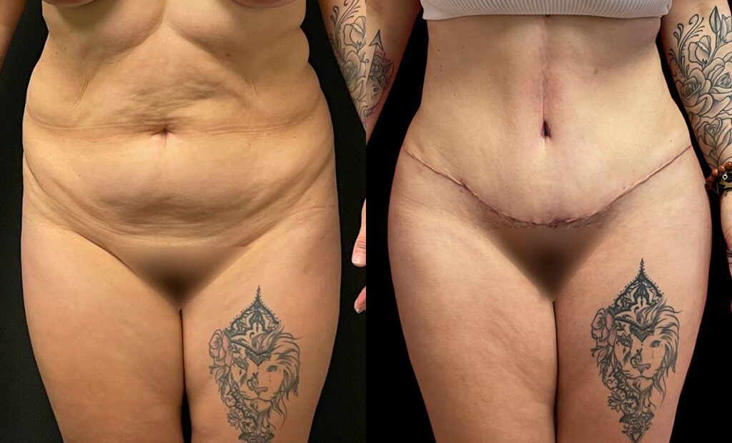 abdominoplasty before and after photo