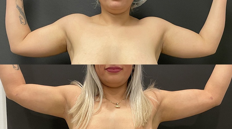 Arm Lipo Before and After Photo by Dr. Jacobson in Beverly Hills California