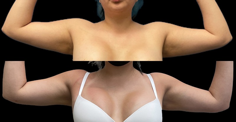 Arm Lipo Before and After Photo by Dr. Jacobson in Beverly Hills California