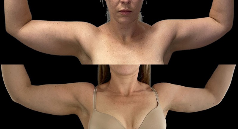 Arm Lipo Before and After Photo by Dr. Jacobson in Beverly Hills California