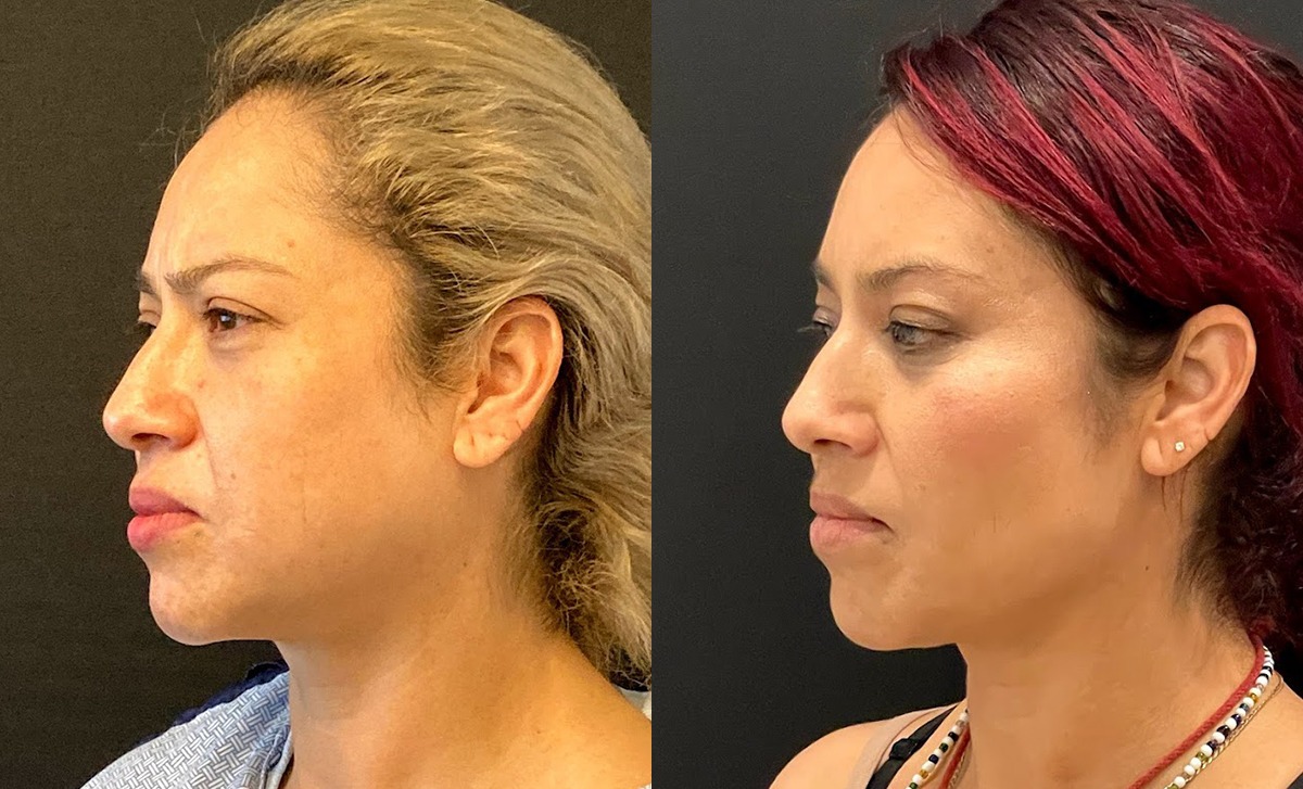 Buccal Fat Removal Before and After Photo by Dr. Jacobson in Beverly Hills California