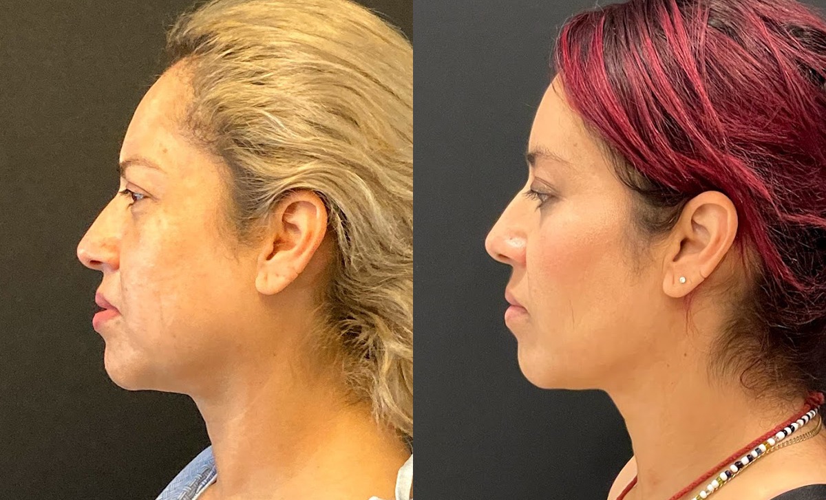 Buccal Fat Removal Before and After Photo by Dr. Jacobson in Beverly Hills California