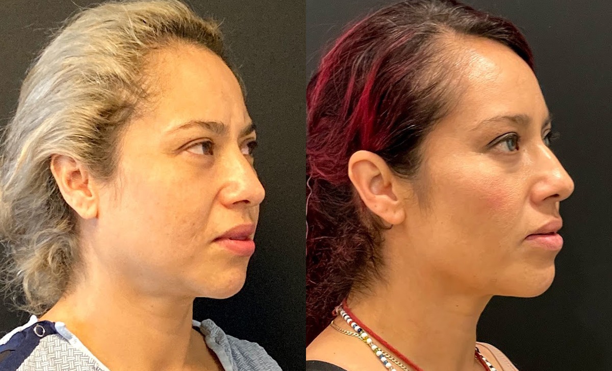 Buccal Fat Removal Before and After Photo by Dr. Jacobson in Beverly Hills California