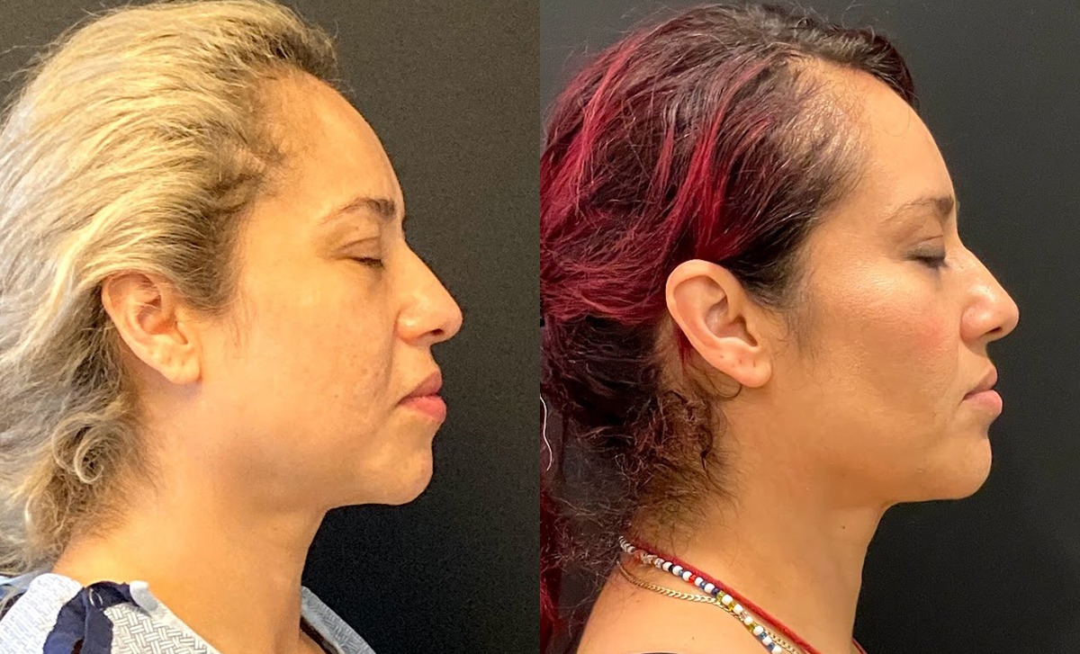 Buccal Fat Removal Before and After Photo by Dr. Jacobson in Beverly Hills California