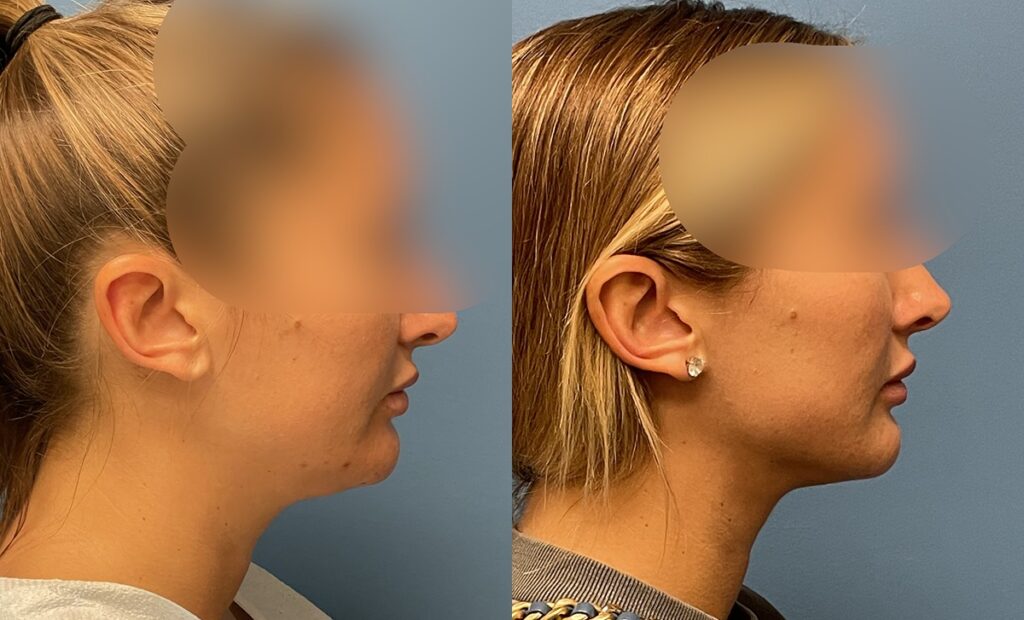 Chin Lipo Before and After Photo by Dr. Jacobson in Beverly Hills California