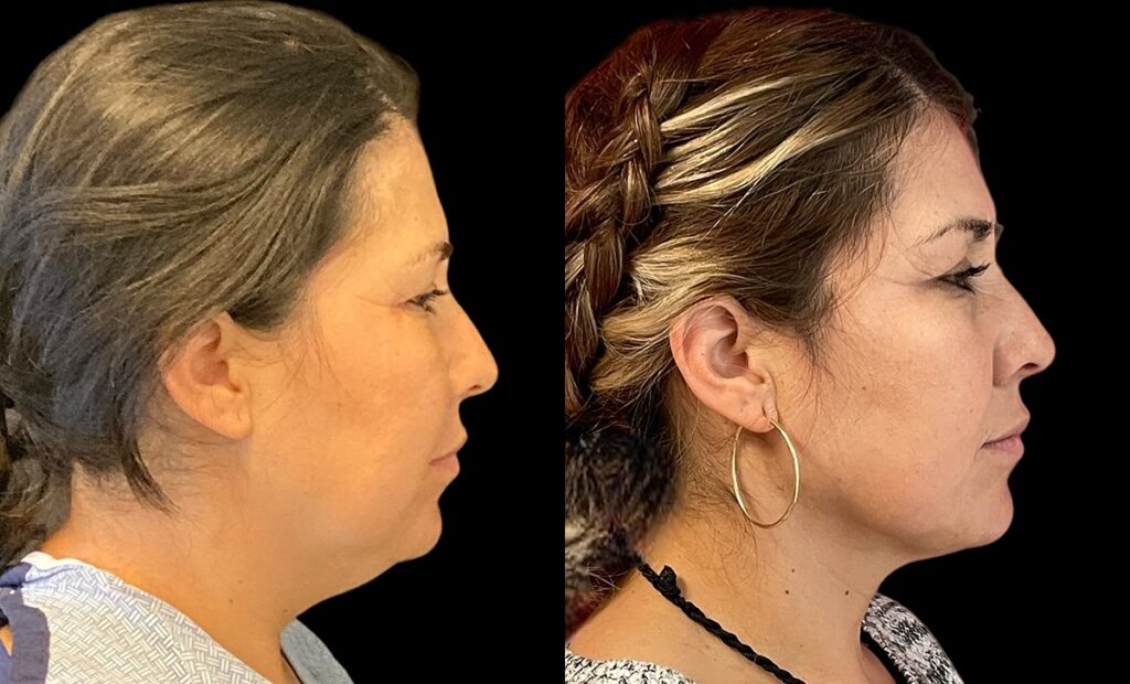 Chin Lipo Before and After Photo by Dr. Jacobson in Beverly Hills California