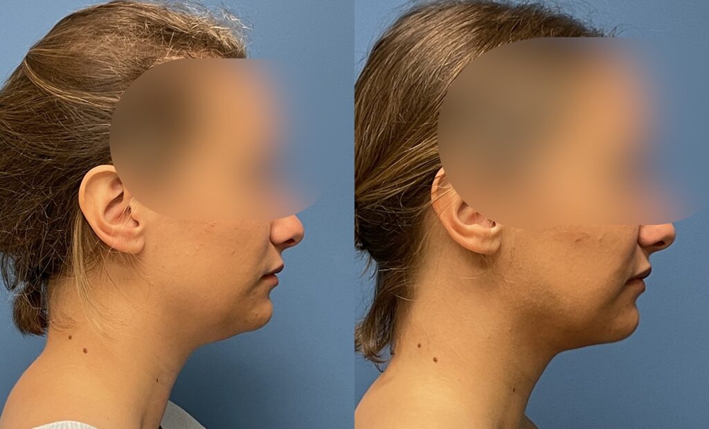 Chin Lipo Before and After Photo by Dr. Jacobson in Beverly Hills California