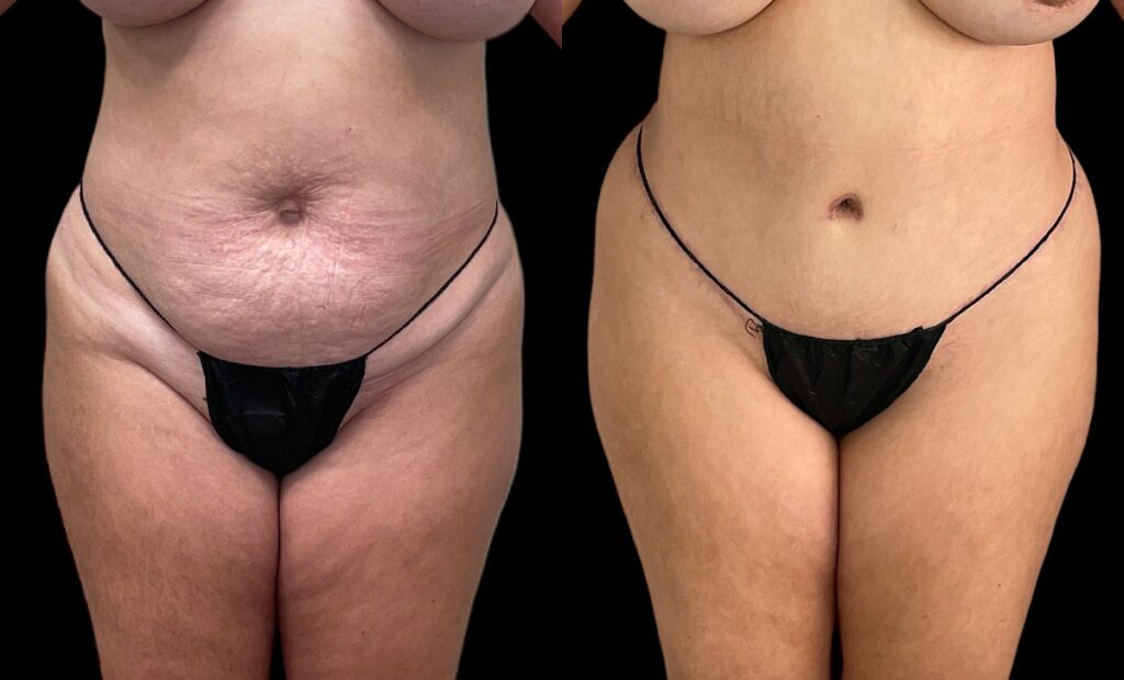 Abdominoplasty Before and After Photo by Dr. Jacobson in Beverly Hills California