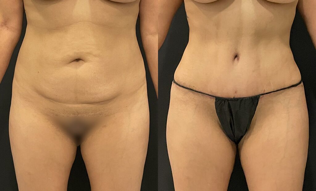 Hi-Def Liposuction Before and After Photo by Dr. Jacobson in Beverly Hills California