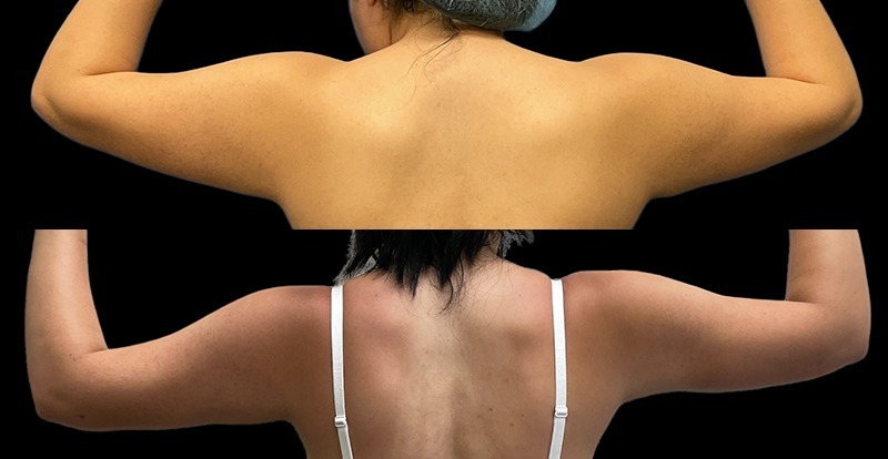Arm Lipo Before and After Photo by Dr. Jacobson in Beverly Hills California
