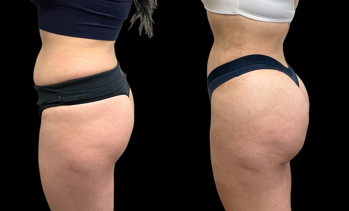 360 Liposuction Before and After Photo by Dr. Jacobson in Beverly Hills California