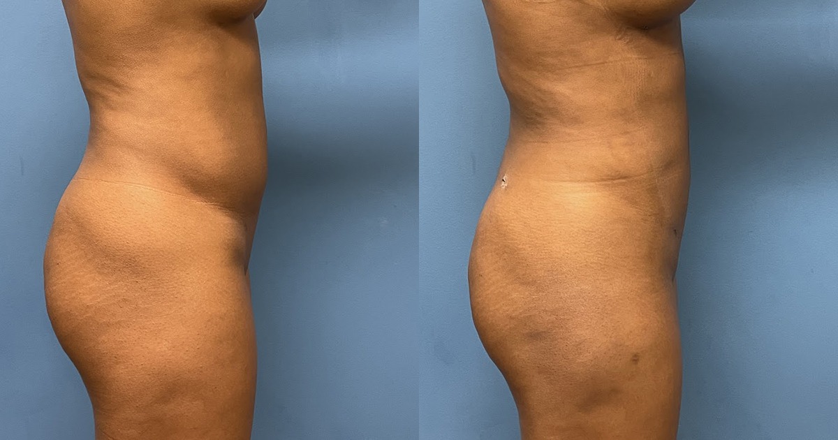 VASER Liposuction Before and After Photo by Dr. Jacobson in Beverly Hills California