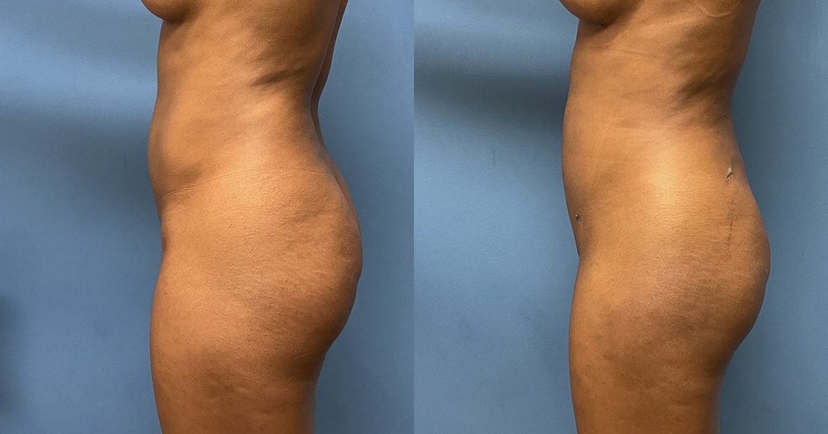 VASER Liposuction Before and After Photo by Dr. Jacobson in Beverly Hills California