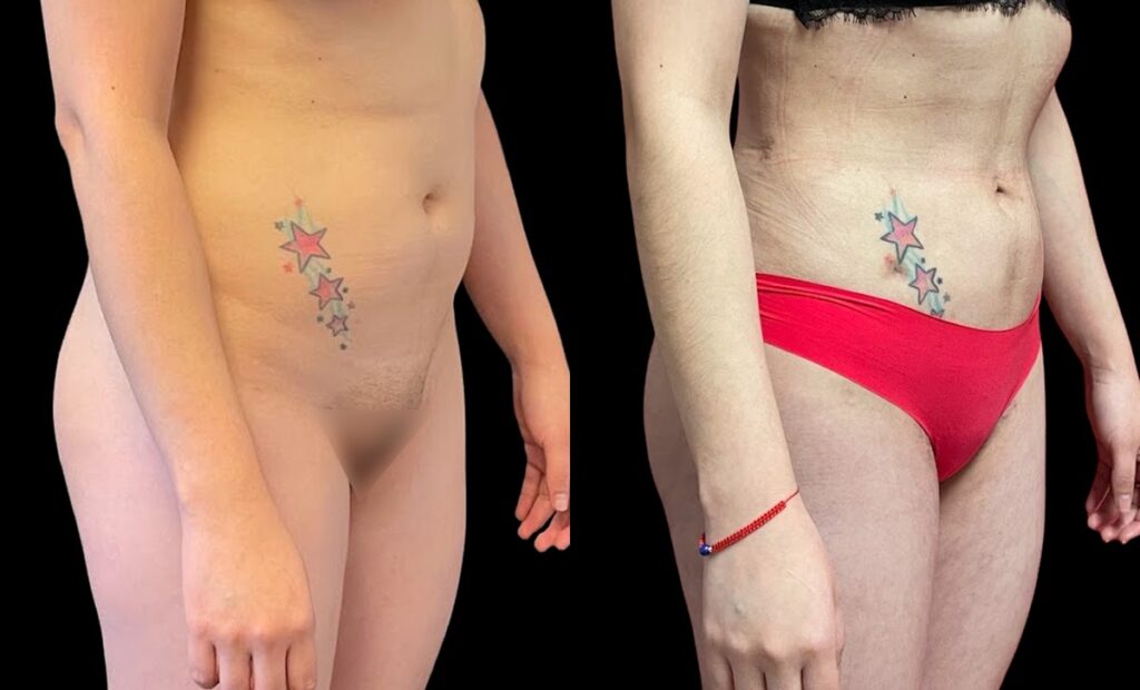 360 Liposuction Before and After Photo by Dr. Jacobson in Beverly Hills California