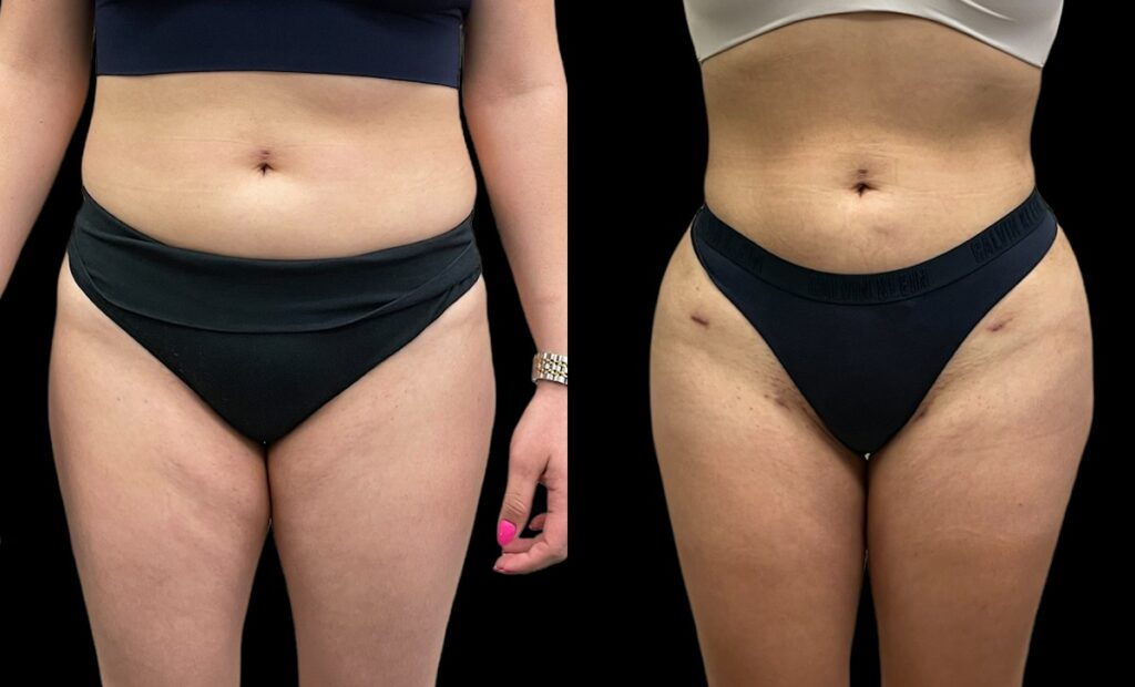 360 Liposuction Before and After Photo by Dr. Jacobson in Beverly Hills California