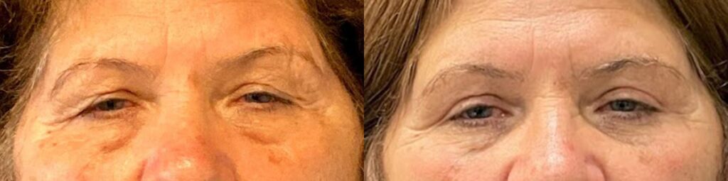 Blepharoplasty Before and After Photo by Dr. Jacobson in Beverly Hills California