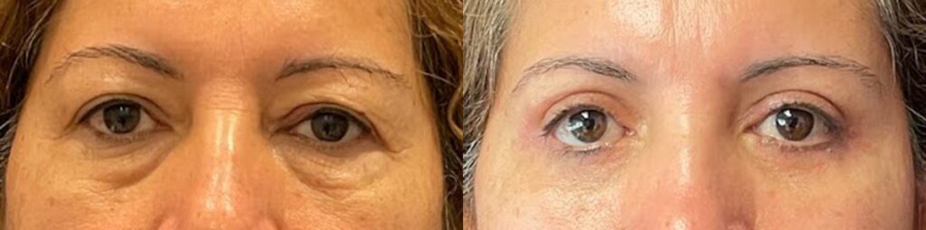 Blepharoplasty Before and After Photo by Dr. Jacobson in Beverly Hills California