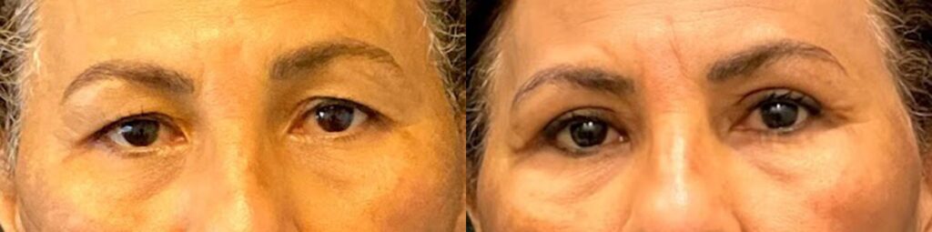 Blepharoplasty Before and After Photo by Dr. Jacobson in Beverly Hills California