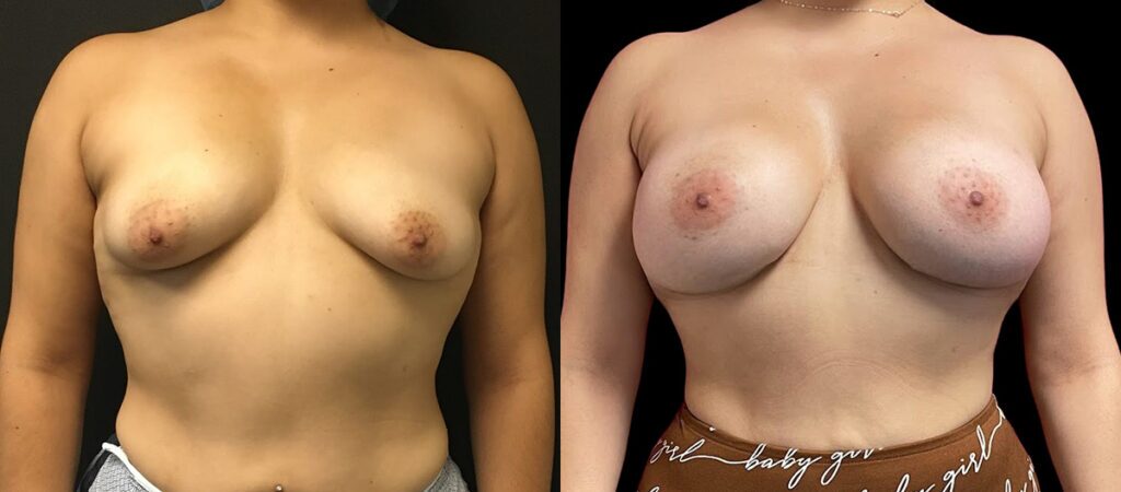 Breast Augmentation Before and After Photo by Dr. Jacobson in Beverly Hills California