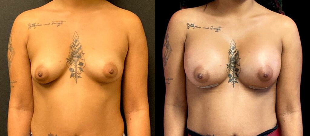 Breast Augmentation Before and After Photo by Dr. Jacobson in Beverly Hills California