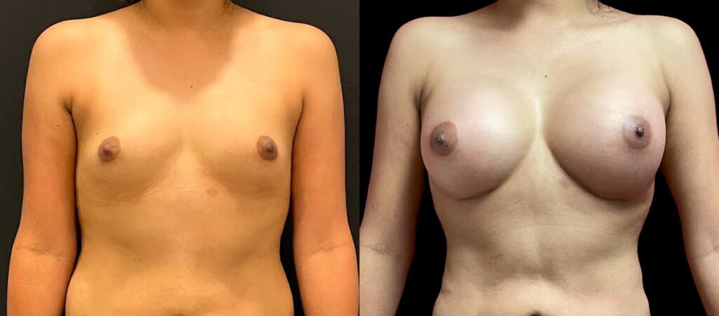 Breast Augmentation Before and After Photo by Dr. Jacobson in Beverly Hills California