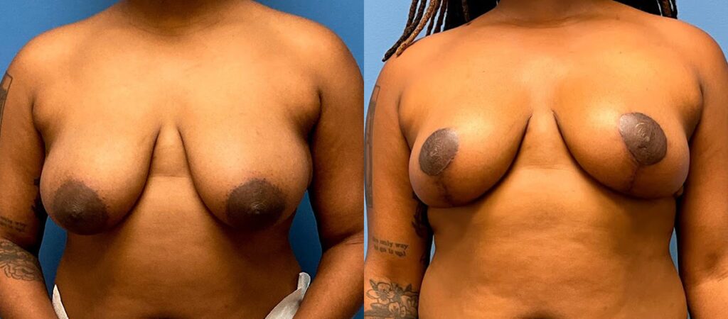 Breast Lift Before and After Photo by Dr. Jacobson in Beverly Hills California