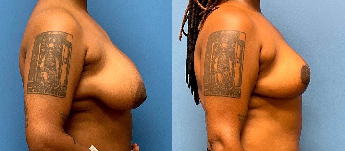 Breast Lift Before and After Photo by Dr. Jacobson in Beverly Hills California