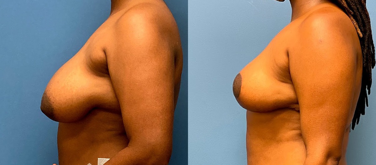 Breast Lift Before and After Photo by Dr. Jacobson in Beverly Hills California