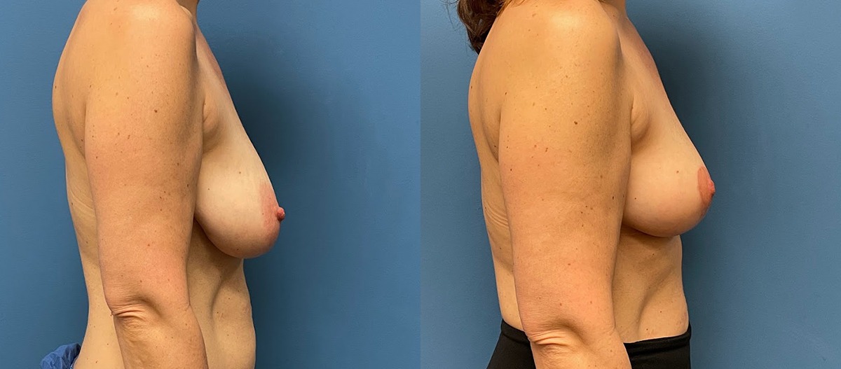Breast Lift Before and After Photo by Dr. Jacobson in Beverly Hills California