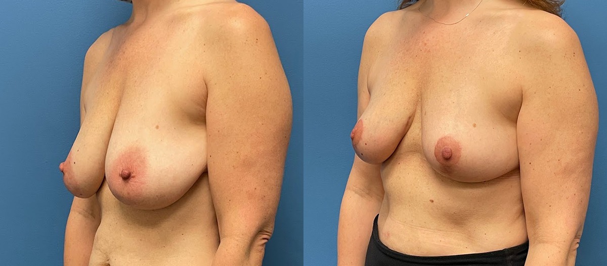 Breast Lift Before and After Photo by Dr. Jacobson in Beverly Hills California