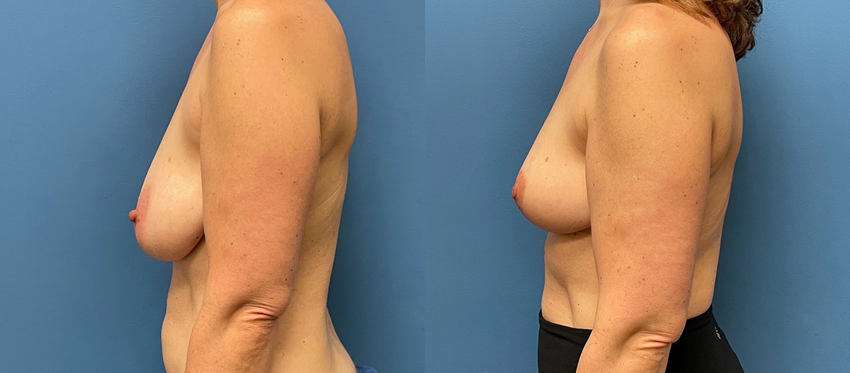 Breast Lift Before and After Photo by Dr. Jacobson in Beverly Hills California