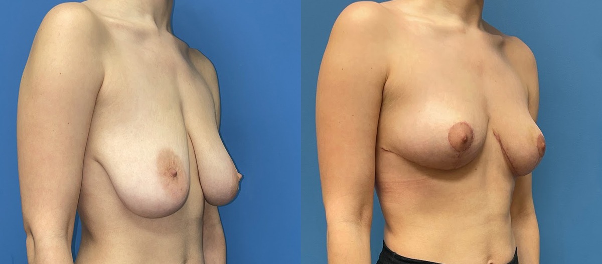 Breast Lift Before and After Photo by Dr. Jacobson in Beverly Hills California