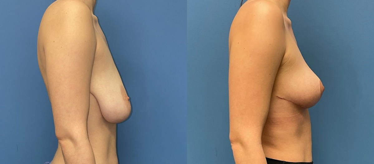 Breast Lift Before and After Photo by Dr. Jacobson in Beverly Hills California