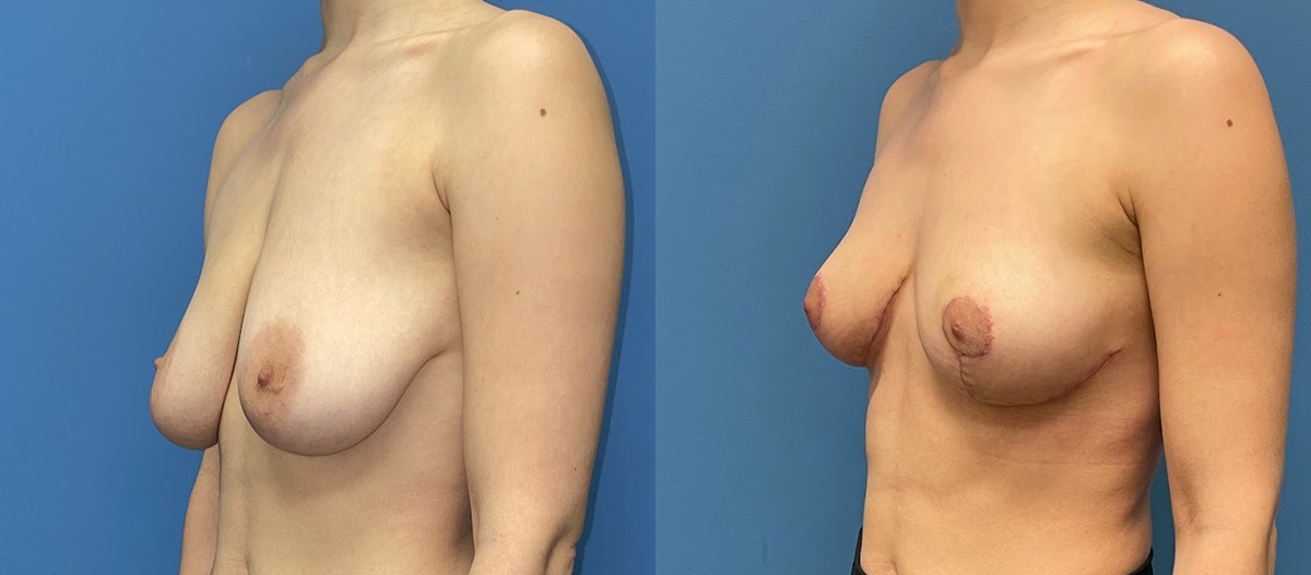 Breast Lift Before and After Photo by Dr. Jacobson in Beverly Hills California