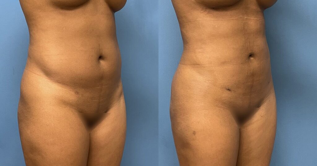 360 Liposuction Before and After Photo by Dr. Jacobson in Beverly Hills California
