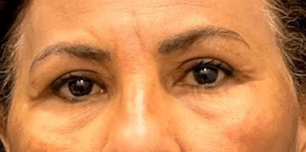 Blepharoplasty after photo by Dr. Jacobson in Beverly Hills, CA Blepharoplasty after photo by Dr. Jacobson in Beverly Hills, CA