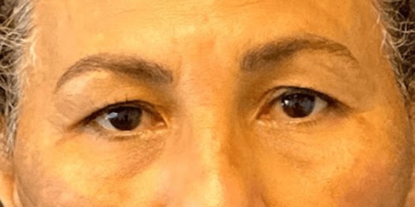 Blepharoplasty before photo by Dr. Jacobson in Beverly Hills, CA Blepharoplasty before photo by Dr. Jacobson in Beverly Hills, CA