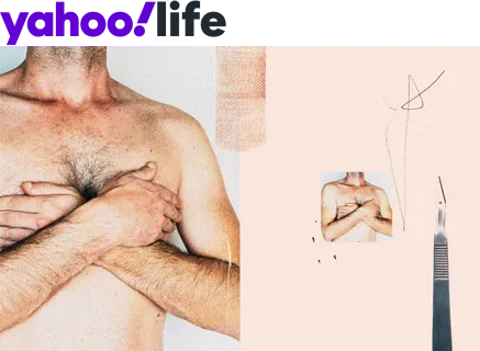 More men are getting breast reductions.