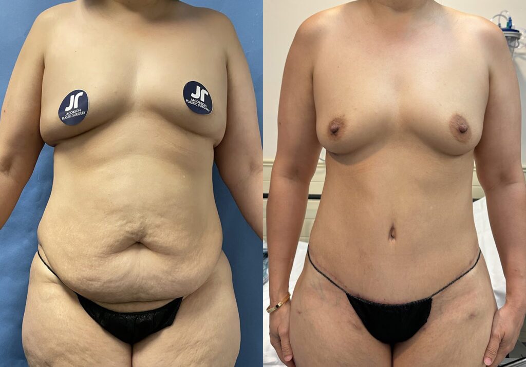 Mommy Makeover Before and After Photo by Jacobson Plastic Surgery in Beverly Hills CA
