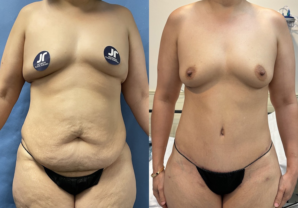 Mommy Makeover Before and After Photo by Jacobson Plastic Surgery in Beverly Hills CA