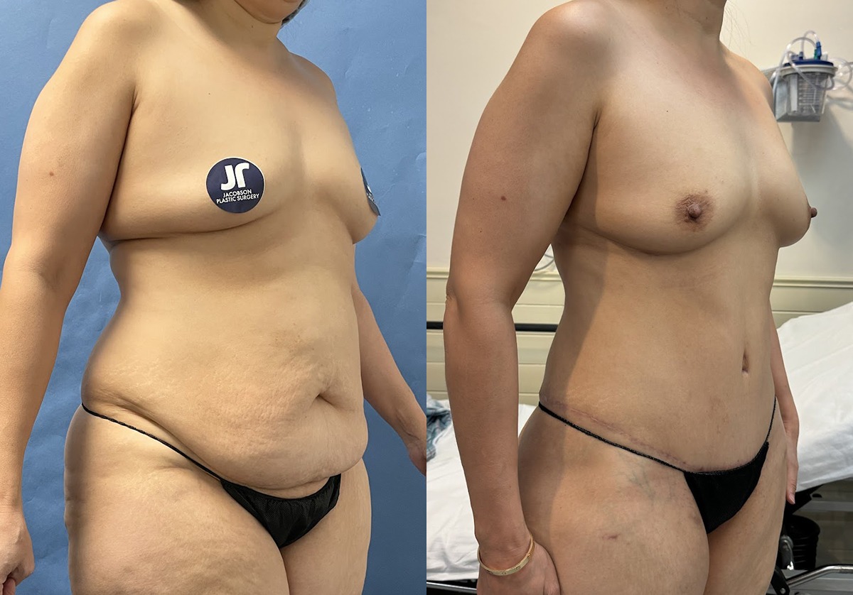 Mommy Makeover Before and After Photo by Jacobson Plastic Surgery in Beverly Hills CA