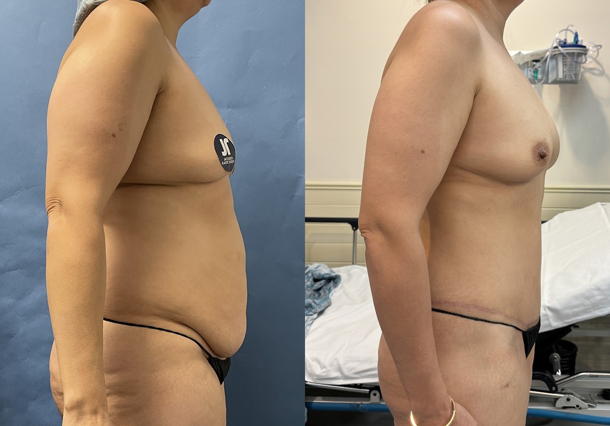 Mommy Makeover Before and After Photo by Jacobson Plastic Surgery in Beverly Hills CA