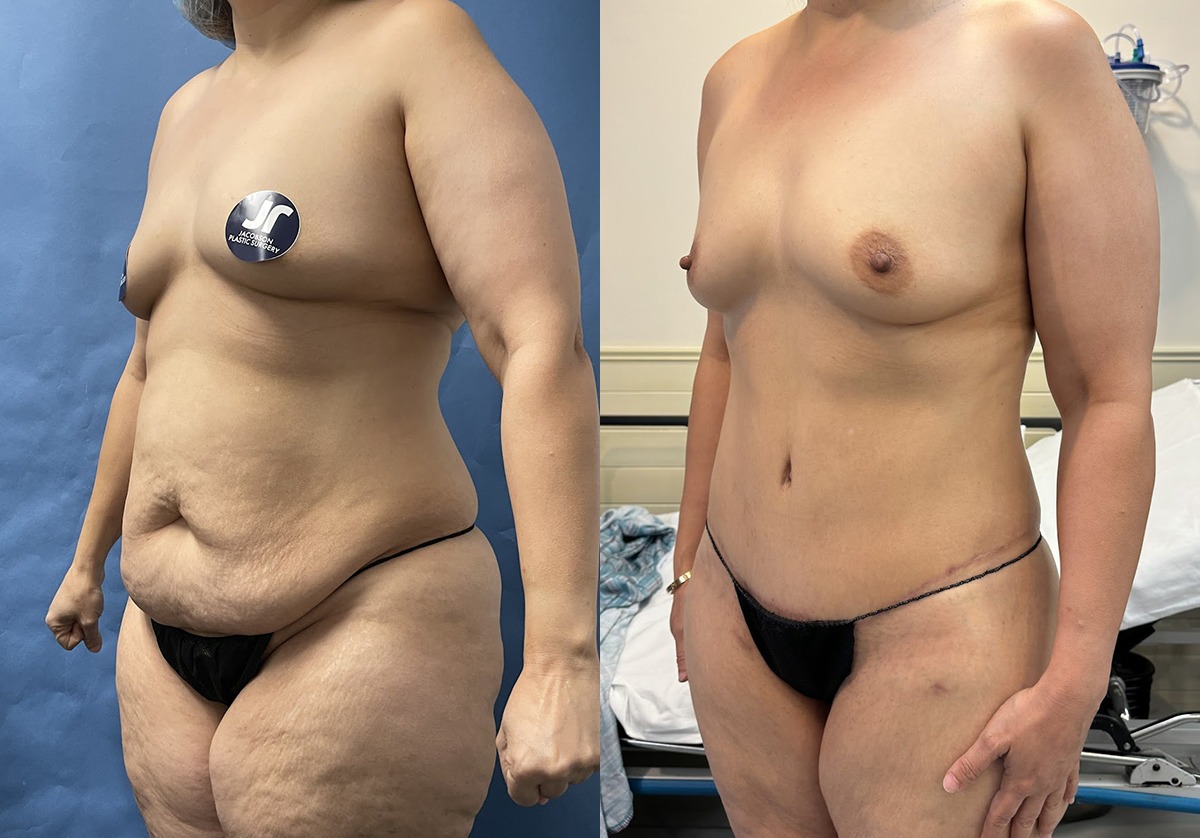 Mommy Makeover Before and After Photo by Jacobson Plastic Surgery in Beverly Hills CA