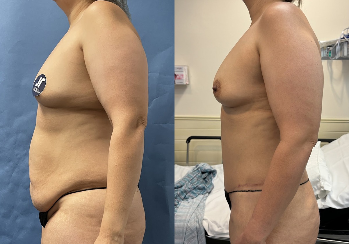 Mommy Makeover Before and After Photo by Jacobson Plastic Surgery in Beverly Hills CA