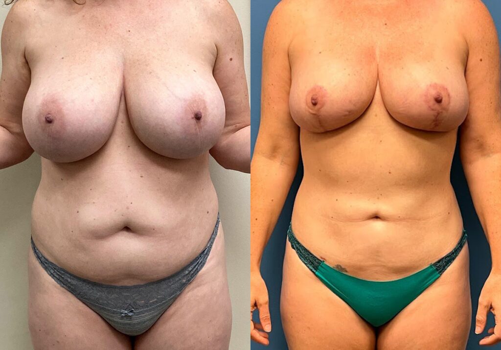 Mommy Makeover Before and After Photo by Jacobson Plastic Surgery in Beverly Hills CA
