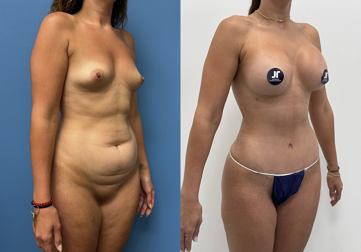 Mommy Makeover Before and After Photo by Jacobson Plastic Surgery in Beverly Hills CA